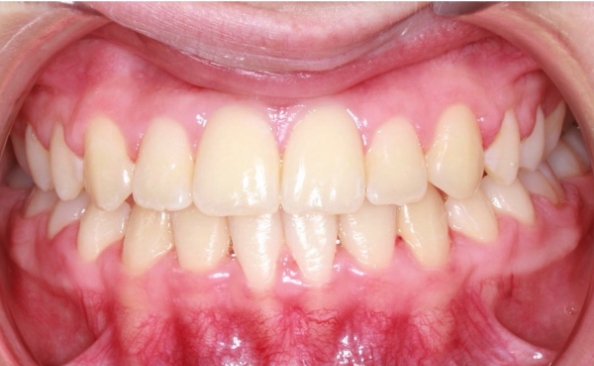 smile after orthodontics