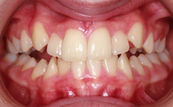 smile before orthodontics