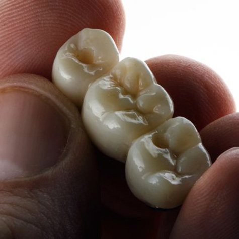 Close-up of hand holding a three-unit dental bridge
