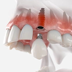 A digital image of a single tooth dental implant
