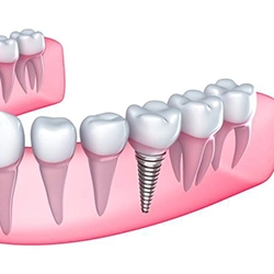 Illustration of single dental implant in lower arch