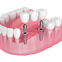 Illustration of dental bridge being attached to dental implants
