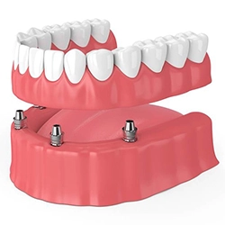 Illustration of dentures being attached to dental implant posts