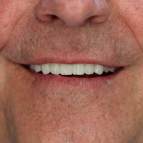 Close-up of patient’s smile after treatment at Landmark Dental Studio