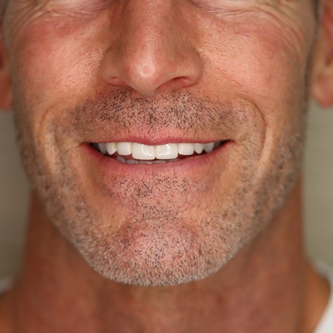 Close-up of man’s smile after treatment at Landmark Dental Studio