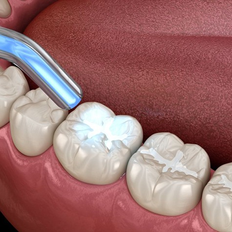 Illustration of curing light being used to harden a tooth-colored filling