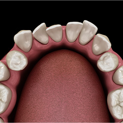 Illustration of crooked teeth viewed from above