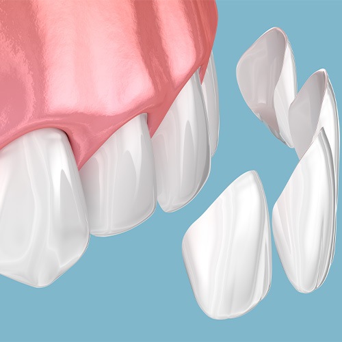 Illustration showing veneers being placed on front teeth