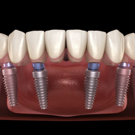 Illustration of fixed implant denture for lower arch