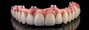 Full arch dental implants
