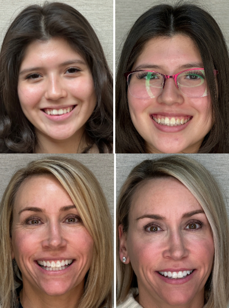 patients results after invisalign