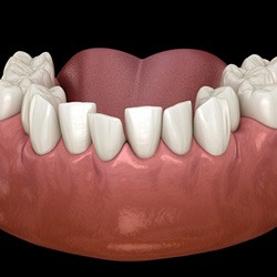 Woman’s smile with gap between the front teeth