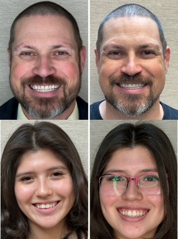 before and after smiles treated by invisalign