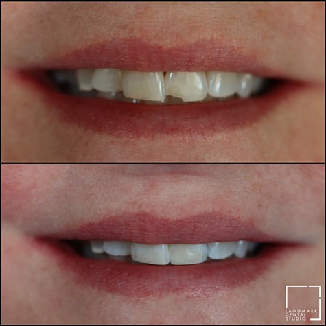 Close-up before and after photos of a smile makeover