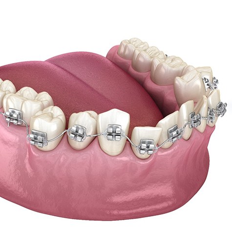 Illustration of braces placed on misaligned teeth