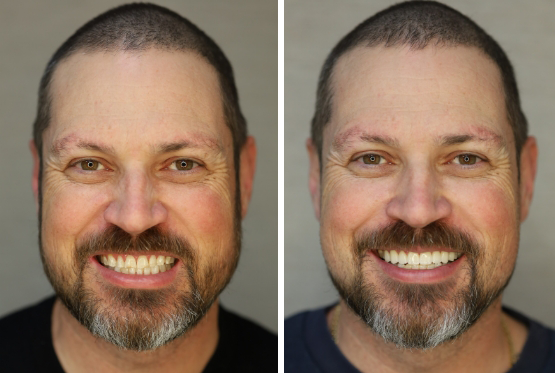 Blonde patient with glasses before and after veneers
