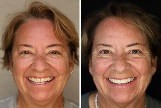 Woman with wavy blonde hair before and after veneers