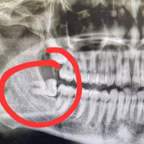 Wisdom tooth circled on dental X-ray