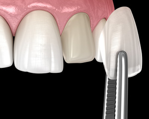Illustration of a veneer being placed on a tooth