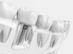Illustration of dental implant in plastic model of mouth